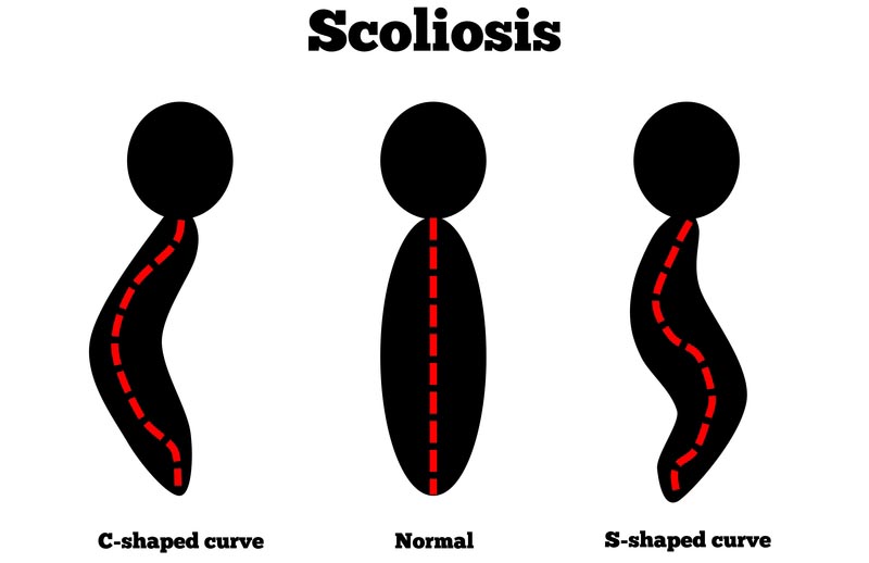 ,  scoliosis treatment